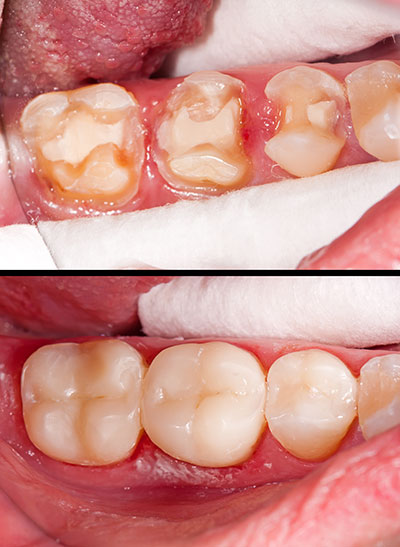 Tooth Colored Fillings