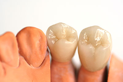 Galesburg Ceramic Crowns