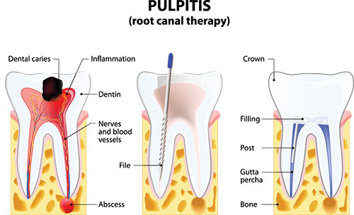Root Canal Therapy in Galesburg