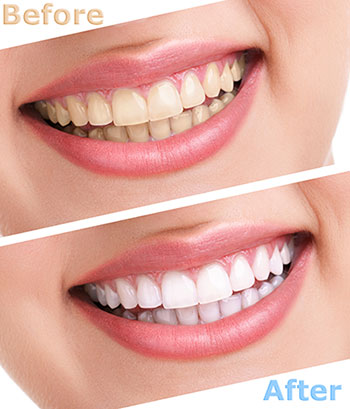 Teeth Whitening and Bleaching - Ross Family Dentistry