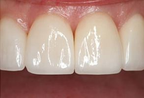 Galesburg Dental Implants