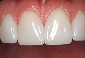 Galesburg Cerec Crowns