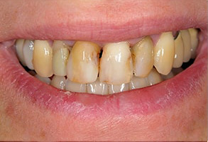 Galesburg Dental Implants